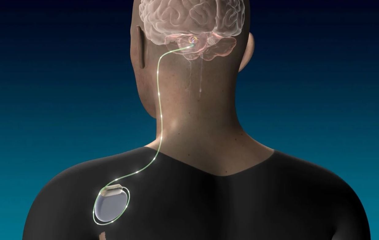 Enspire DBS_Device Image