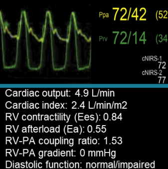 Continuous Right Ventricular Hemodynamic Monitoring